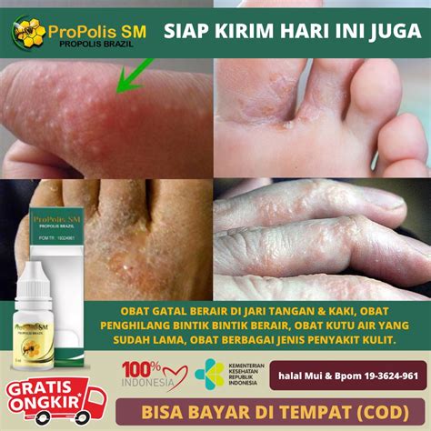 Jual Obat Gatal Berair Di Jari Tangan Dan Kaki Obat Gatal Penghilang