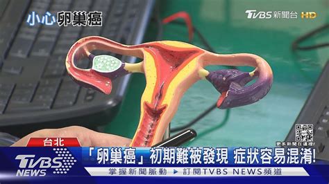 您是「卵巢癌」高風險族群嗎 體內驗出這個基因罹癌風險高｜十點不一樣20211223 Youtube