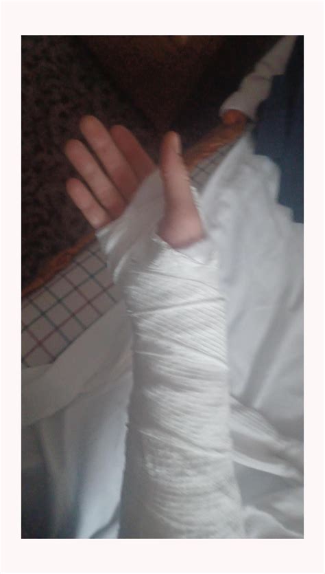 Goodbye old friends : r/Neverbrokeabone