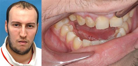 Cellulitis Dental