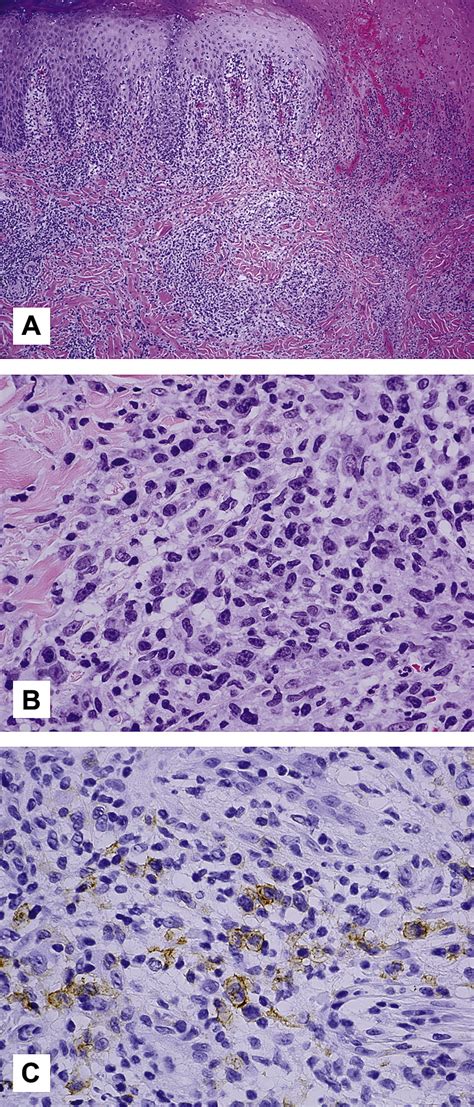 Acral Lymphomatoid Papulosis Journal Of The American Academy Of