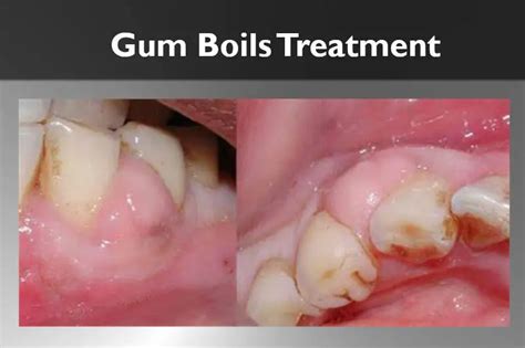 Gum Boils Treatment The Powerful Solution You Need