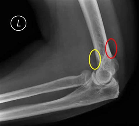 Right Elbow X Ray Fat Pad