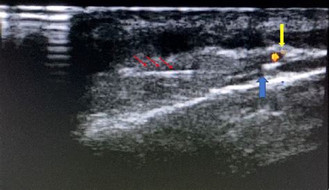 Transverse ultrasound image of the greater occipital nerve (blue ...