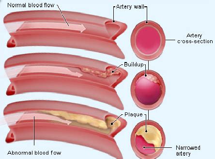 Diagram showing high blood cholesterol | Download Scientific Diagram