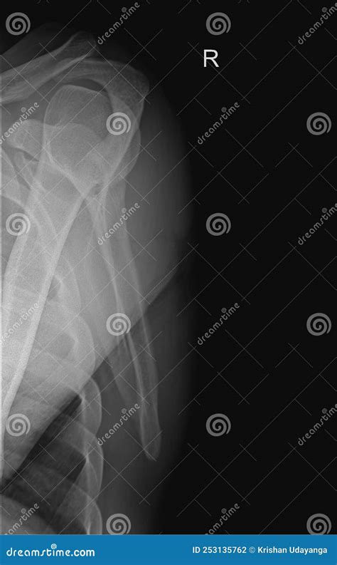 Scapula Y Stock Photos - Free & Royalty-Free Stock Photos from Dreamstime