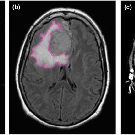 MRI/CT measurements of tumor and edema (a+b) and edema and hemorrhage ...