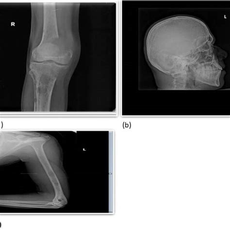 Radiograph Of Knee Showing The Lytic Lesion In The Distal Femur And