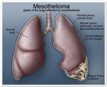 Mesotheliome Le Guide Amiante