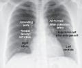 Pulmonary Diagnostic Tests Flashcards Quizlet