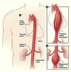 Aortic aneurysm - Wikipedia