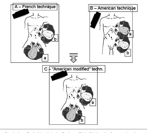 Figure 1 From Laparoscopic Cholecystectomy Technical Compromise Between French And American