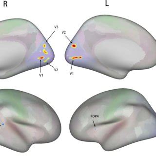 Brain Regions With Significant Differences In Cortical Thickness In PHN