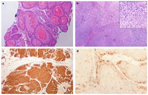 Head And Neck Squamous Cell Carcinoma Abstract Europe Pmc Hot Sex Picture