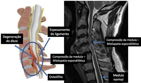 Mielopatia Cervical Causas Sintomas Diagnóstico E Tratamentos