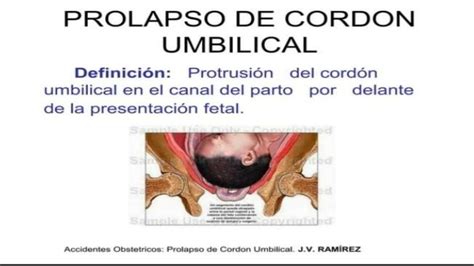 prolapso de cordón umbilical Escuela medica uDocz