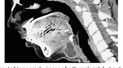 Figure 3 From Congenital Cervical Cysts Sinuses And Fistulae In