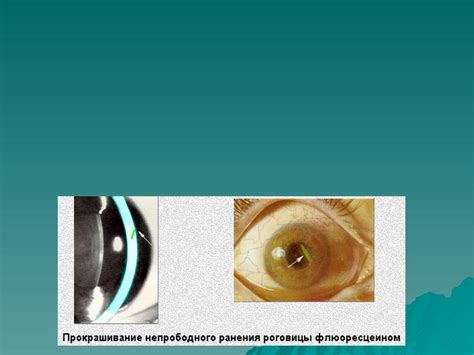 Презентация на тему: Травмы органа зрения