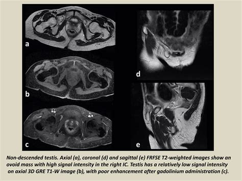 Presentation1 Radiological Imaging Of Undescended Testis Ppt