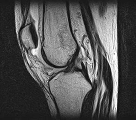 Transient Lateral Patellar Dislocation Image Radiopaedia Org