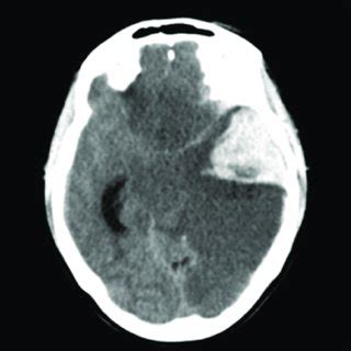 CT scan of head on admission showing an intracerebral hematoma and ...