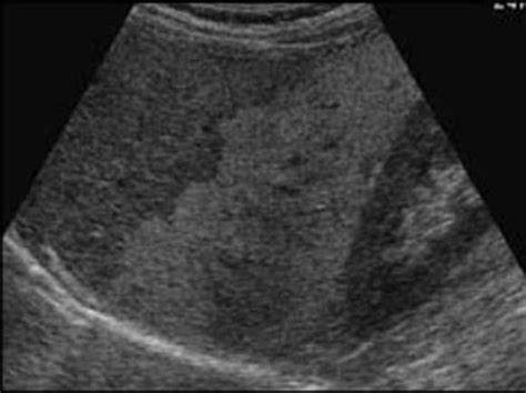 Liver Geographic Fatty Infiltration Of The Liver Medical Ultrasound