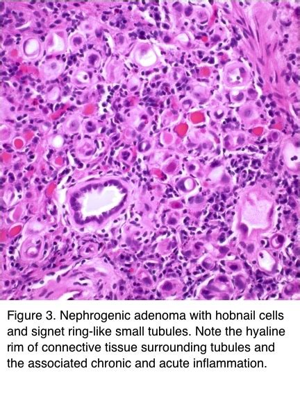 Pathology Outlines Nephrogenic Metaplasia Adenoma