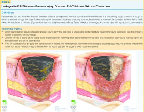 4 Stages Of Pressure Ulcers