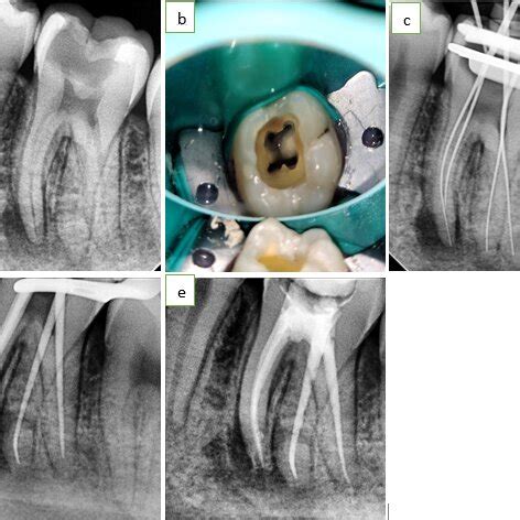 A Pre Operative Radiograph Showing Additional Root Wrt B Canal