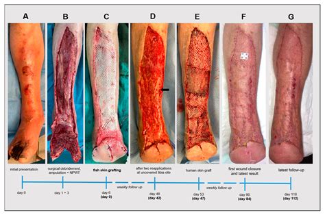 The Use of Intact Fish Skin Grafts in the Treatment of Necrotizing