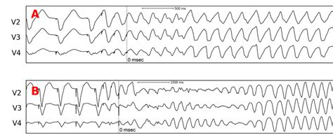 precordial ecg leads     recorded  induction