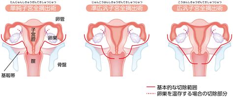 手術療法 子宮体がん Msd Oncology がんを生きる