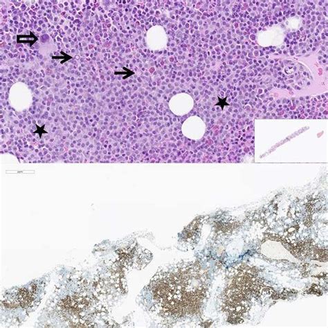 Kidney Biopsy A Light Microscopy Showing Glomerulus With Nodular
