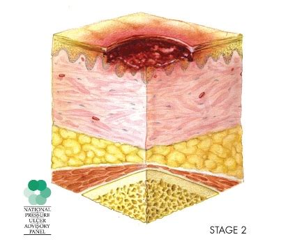 Nursing Homes And Pressure Ulcers Bed Sores