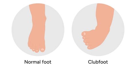 Premium Vector Clubfoot