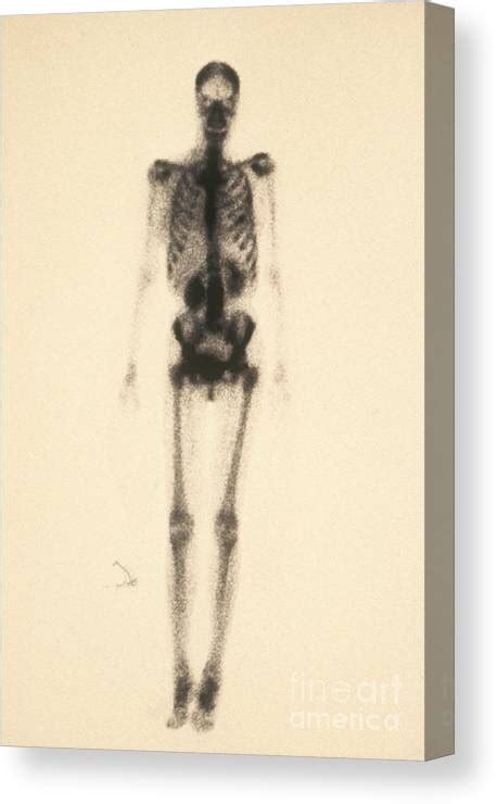 Normal Bone Scan