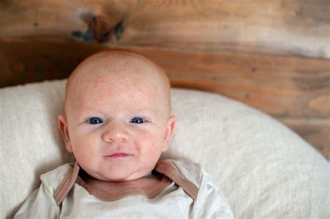 Allergien Atopic Dermatitis Auf Dem Gesicht Stockbild Bild Von