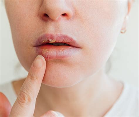 Herpes Labiale Cos Quando Preoccuparsi Cause E Rimedi