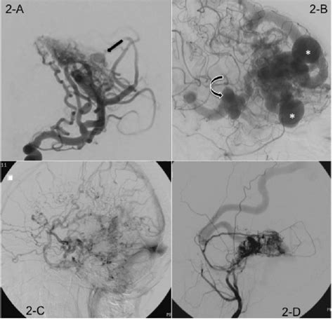 A Left Internal Carotid Artery Angiogram Arterial Phase In Oblique