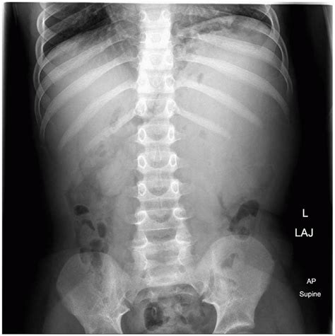 Pediatric Genitourinary Tract Obgyn Key