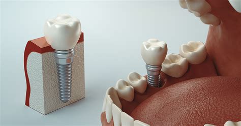 Implantes dentales preguntas frecuentes sobre la implantología dental