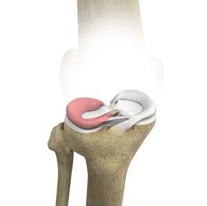 Lateral Meniscus Syndrome Seattle, WA | Meniscus Repair Edmonds, Mercer ...