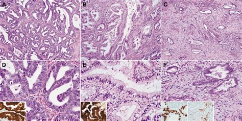 Stromal P16 Overexpression In Gastric Type Mucinous Carcinoma Of The