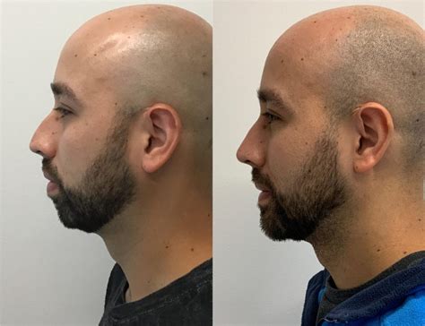 Male Chin Implant Before And After