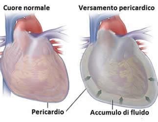 Pericardite