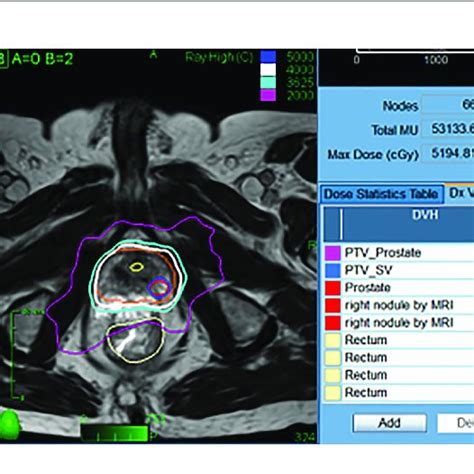 Pdf Rationale For Utilization Of Hydrogel Rectal Spacers In Dose