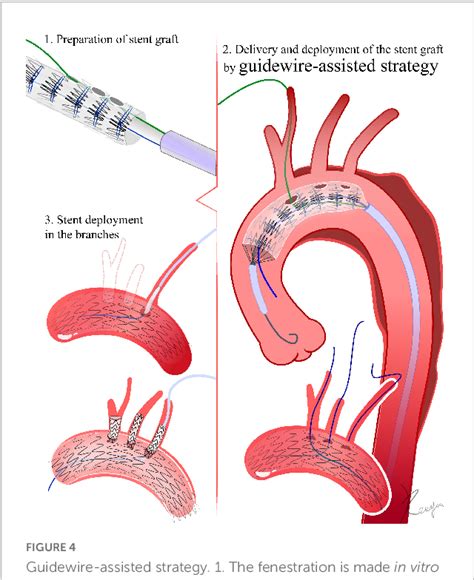 Figure 4 From Technical Details Of Thoracic Endovascular Aortic Repair