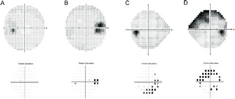 Visual Field Defects Diagram