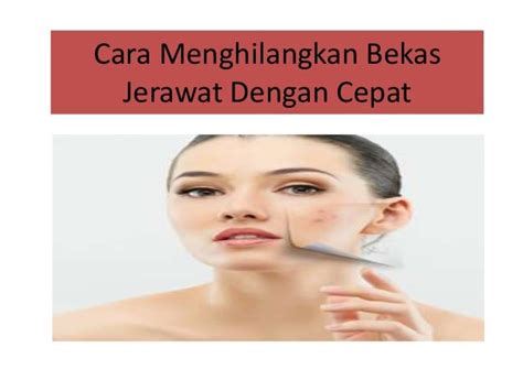 Cara Menghilangkan Bekas Jerawat Dengan Cepat