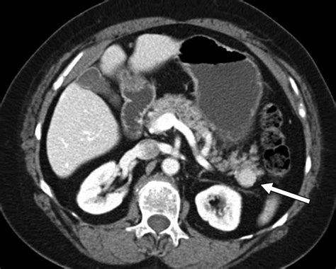 Ct Of Splenosis Patterns And Pitfalls Ajr